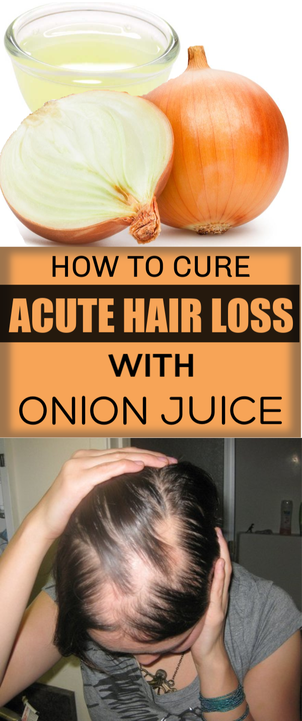 ONION JUICE RECIPE FOR HAIR LOSS AND HAIR GROWTH