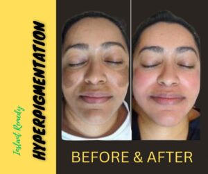 SKIN TONER FORMULA FOR PIGMENTATION AND DARK SPOTS