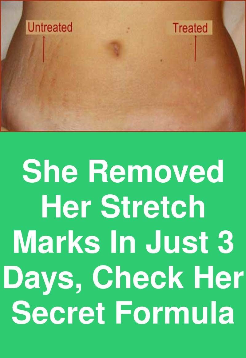 Natural Ways To Remove Stretch Marks