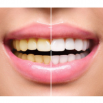HOW TO WHITEN TEETH IN TWO MINUTES?