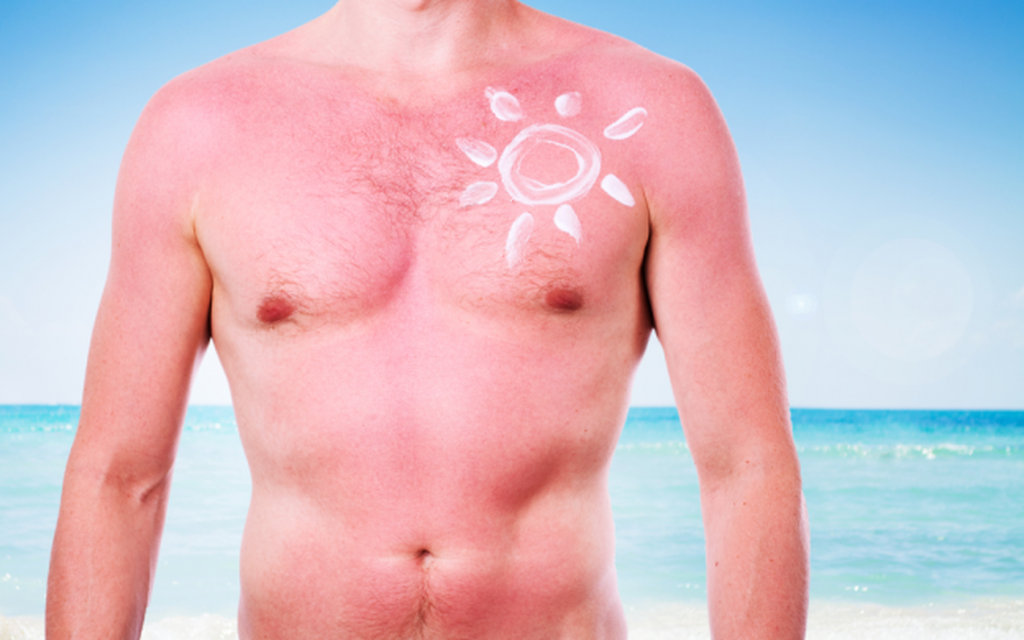 how-to-treat-sunburn-naturally-at-home