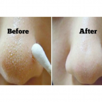 SIMPLE HOMEMADE BLACKHEAD REMOVAL REMEDY
