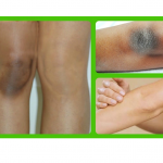 SKIN LIGHTENING MASK FOR DARK ELBOWS AND KNEES