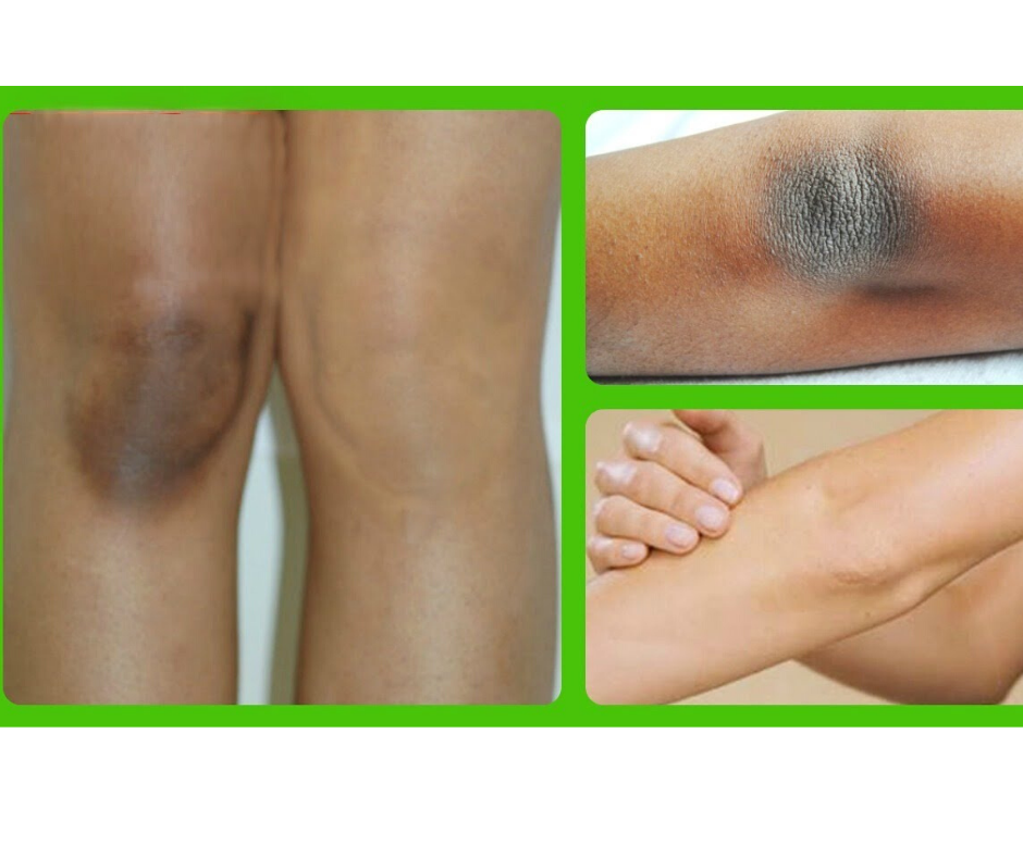 SKIN LIGHTENING MASK FOR DARK ELBOWS AND KNEES