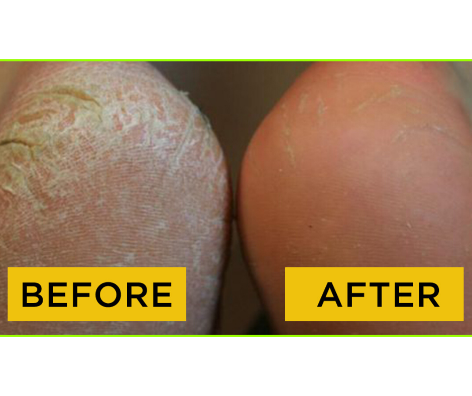 DIY SKINCARE MASK FOR CRACKED HEELS