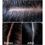 DIY HAIR MASK FOR DANDRUFF GROWTH