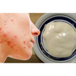 DIY BAKING SODA MASK FOR ACNE