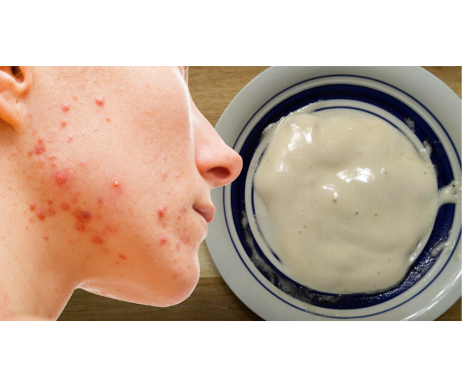 DIY BAKING SODA MASK FOR ACNE