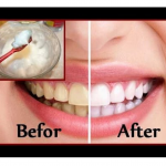 DIY REMEDY FOR YELLOW TEETH