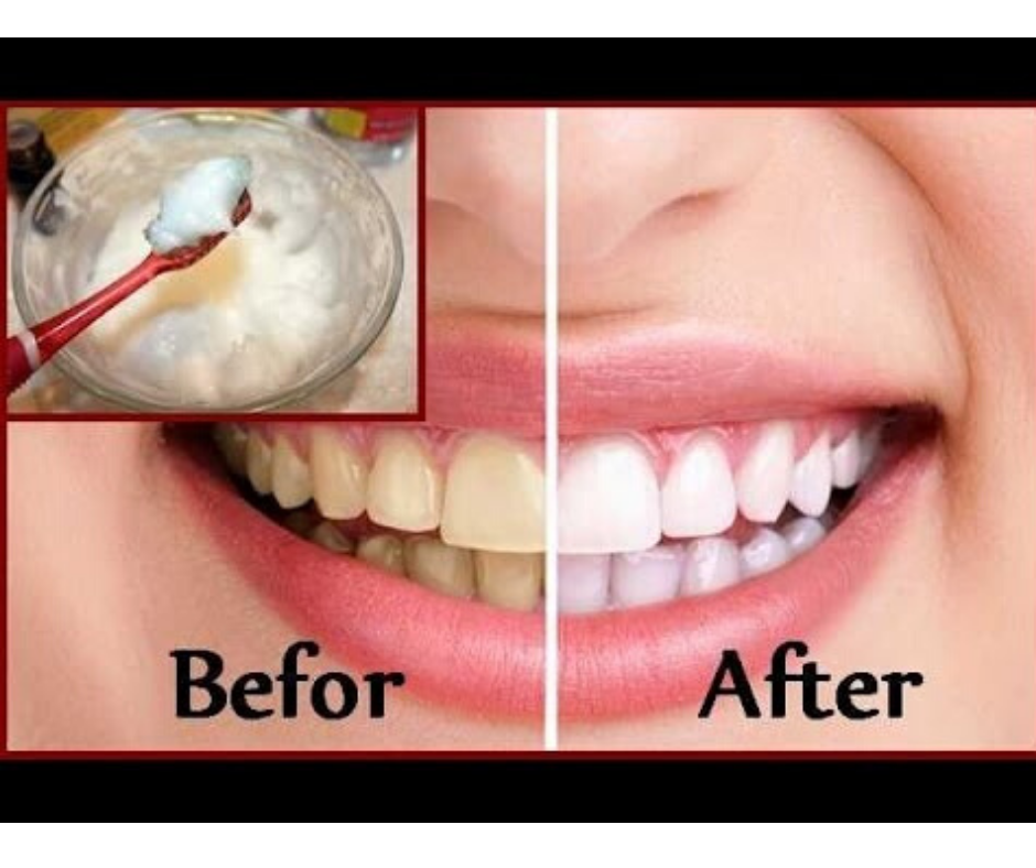 DIY REMEDY FOR YELLOW TEETH