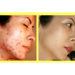DIY HOMEMADE ACNE REMOVAL MASK