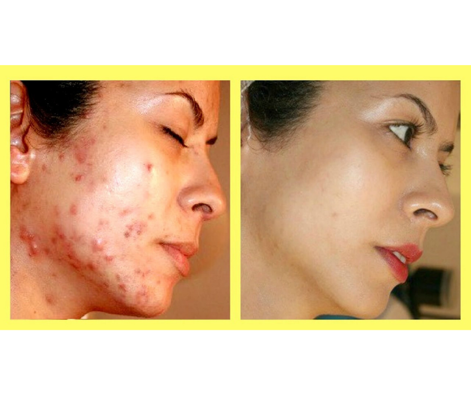 DIY HOMEMADE ACNE REMOVAL MASK