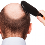 DIY HAIR TONIC FOR BALD PATCHES