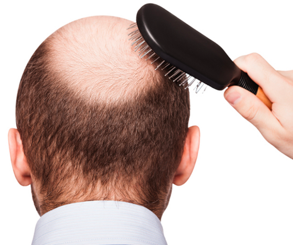 DIY HAIR TONIC FOR BALD PATCHES