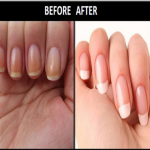 HOW TO GET RID OF YELLOW NAILS