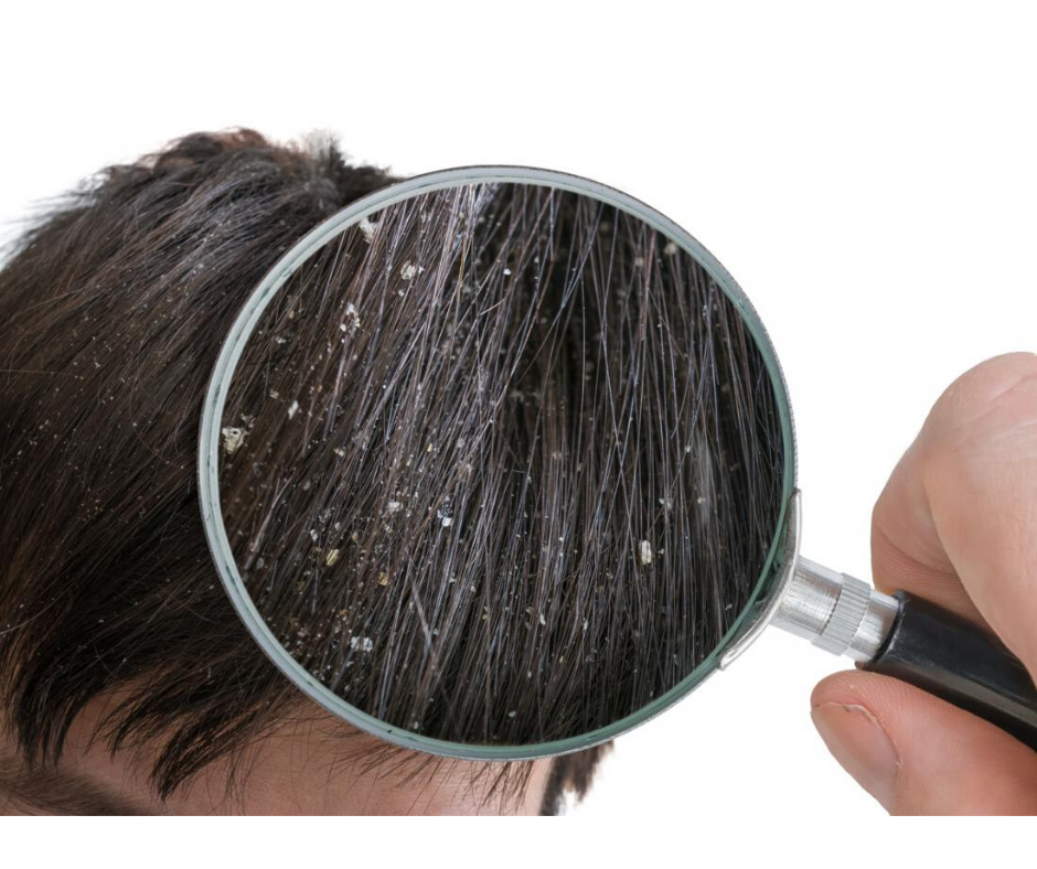HOMEMADE ORGANIC ANTI-DANDRUFF SHAMPOO