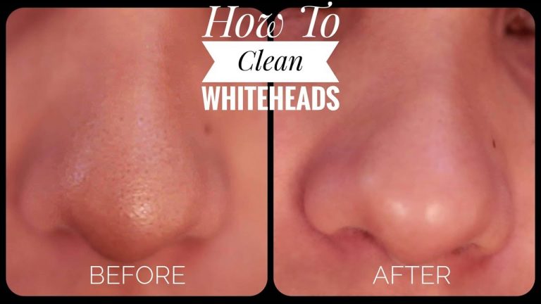 Natural Cures To Get Rid Of Whiteheads Instantly 