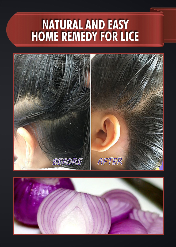 NATURAL AND EASY HOME REMEDY FOR LICE