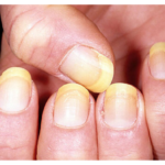 DIY NAIL REMEDY FOR YELLOW NAILS