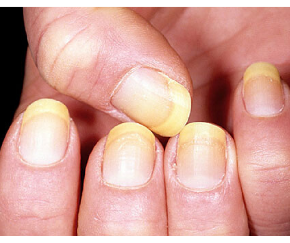 DIY NAIL REMEDY FOR YELLOW NAILS