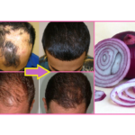 HOMEMADE ONION HAIR MASK FOR HAIR REGROWTH