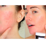DIY SKINCARE MASK FOR ACNE SCARS