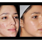DIY HOMEMADE ACNE FACE MASKS