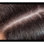 DIY HAIR CARE MASK TO REMOVE DANDRUFF