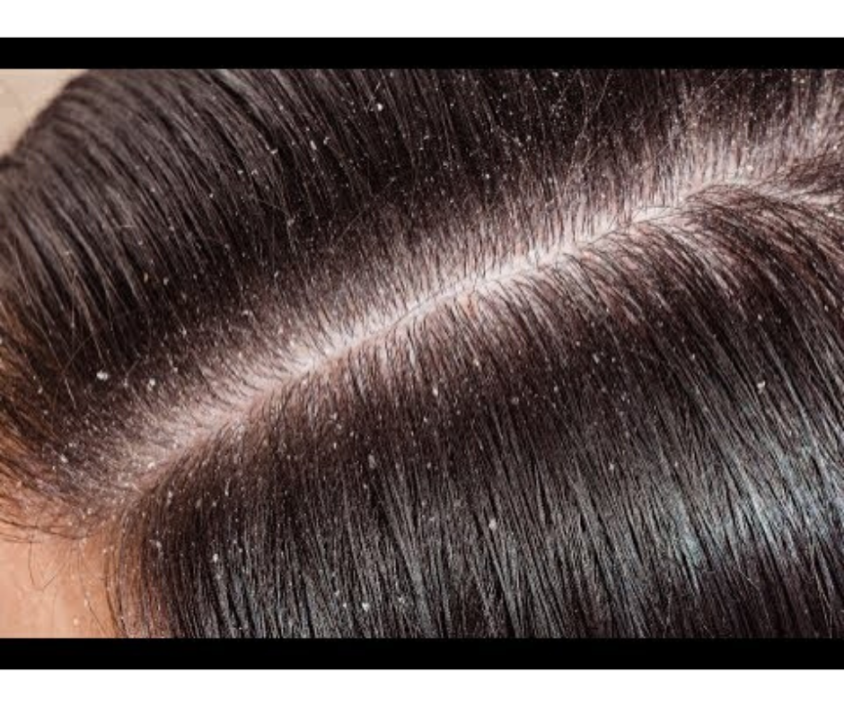 DIY HAIR CARE MASK TO REMOVE DANDRUFF