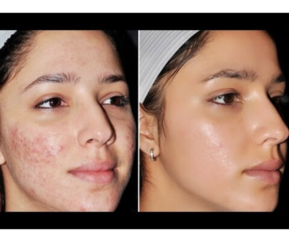 DIY HOMEMADE ACNE FACE MASKS V Beautify