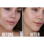 DIY SKINCARE MASK FOR ACNE SCARS