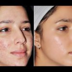 Skin Problems After Marriage and How to Deal with Them?