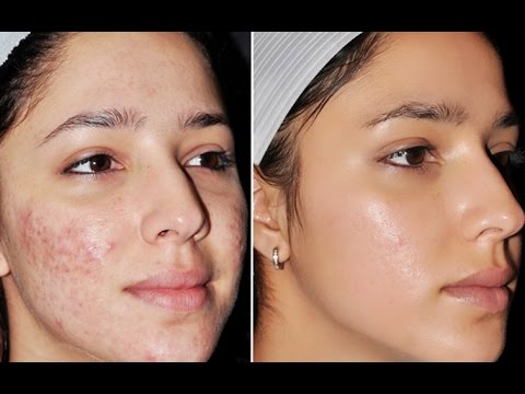 Skin Problems After Marriage and How to Deal with Them?