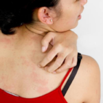 DIY REMEDY FOR BODY RASHES CAUSED BY HARSH FABRICS