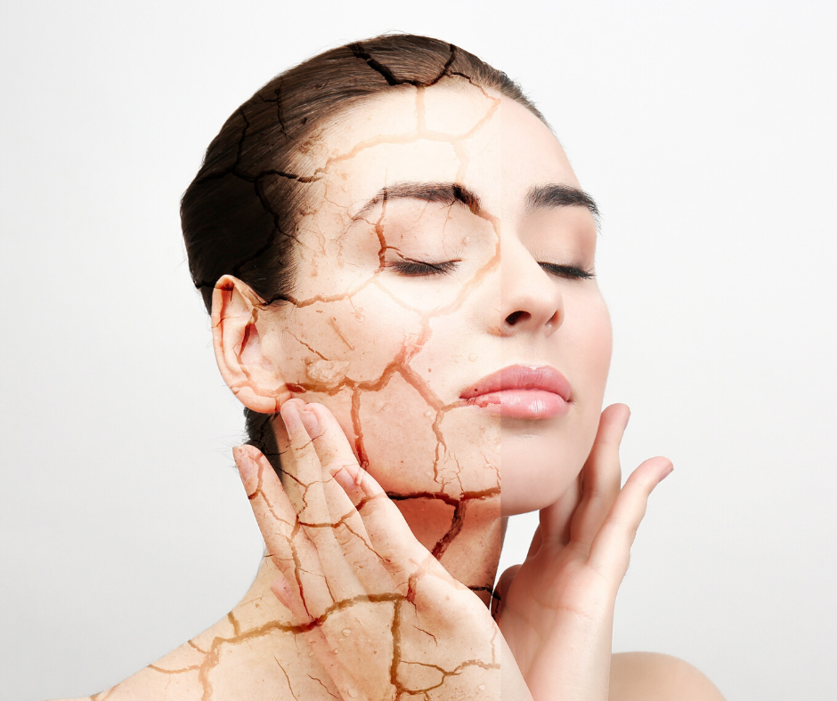DIY SKIN MOISTURIZER FOR DRY AND FLAKY SKIN