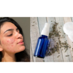 MAKE A TONER TO REMOVE ACNE