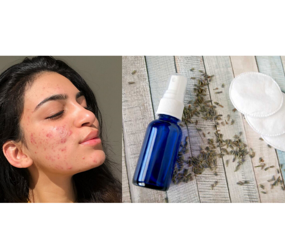MAKE A TONER TO REMOVE ACNE