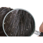 DIY HAIR OIL TO GET RID OF DANDRUFF