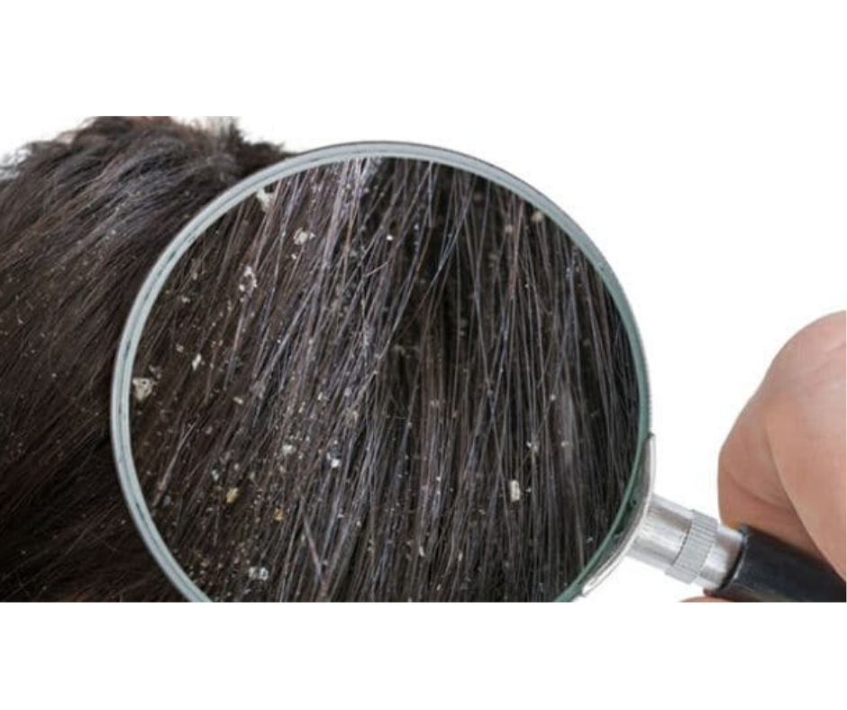 DIY HAIR OIL TO GET RID OF DANDRUFF