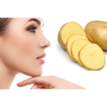 DIY POTATO MASK FOR REDUCING SUNBURN MARKS