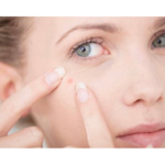 DIY FACE MASK FOR REMOVING ACNE