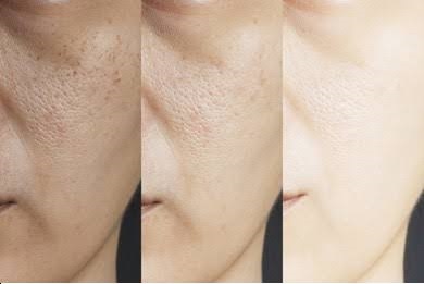 Natural Remedies for Brightening Up Our Dull Skin