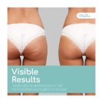 Natural treatments for cellulated buttocks