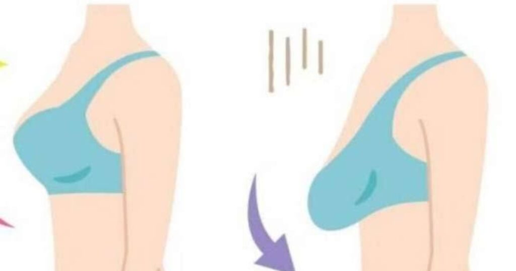 Saggy Breasts