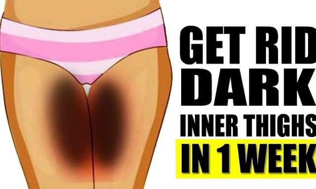 remedies-for-dark-inner-thighs-to-get-lighter-skin-naturally-v-beautify