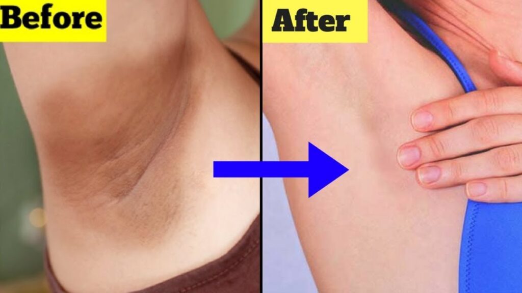 remedies for dark underarms