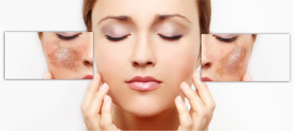 Skin Pigmentation Remedies 