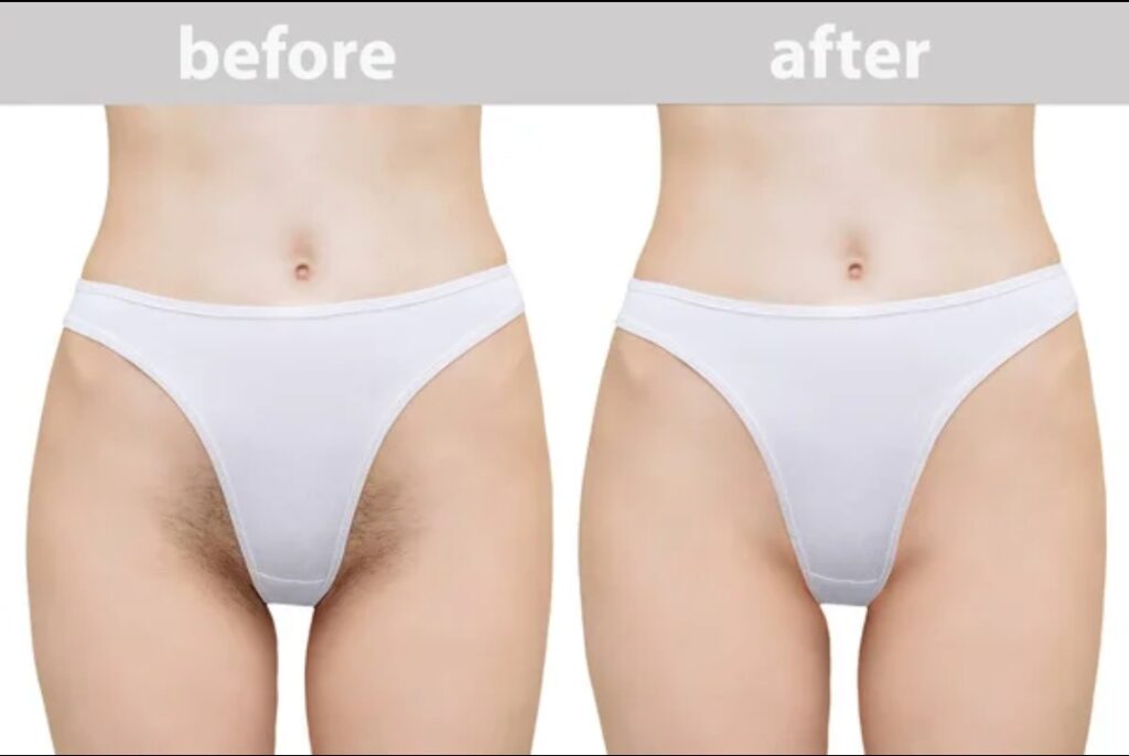 Epilation of hair in the bikini area