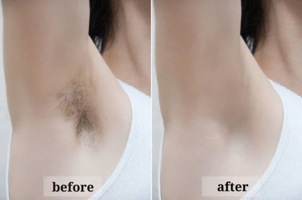 Remedies to remove underarm and underleg hair
