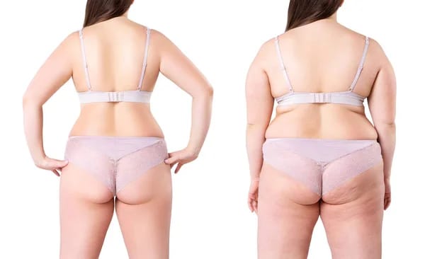 Remedies for Cellulite and Weight Loss